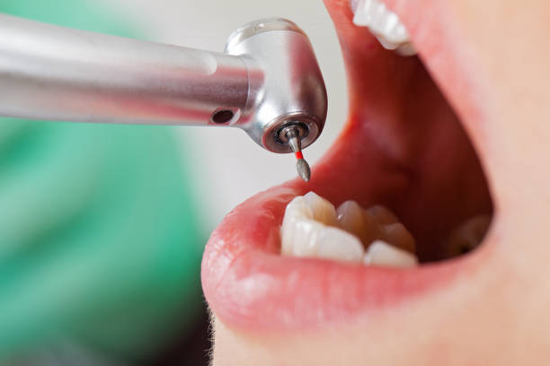 Best Knocked-Out Tooth Emergency  in Coloma, MI